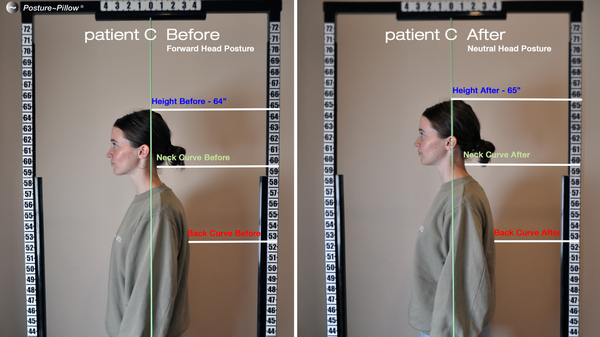 Patient-C-before---after Posture~Pillow therapy